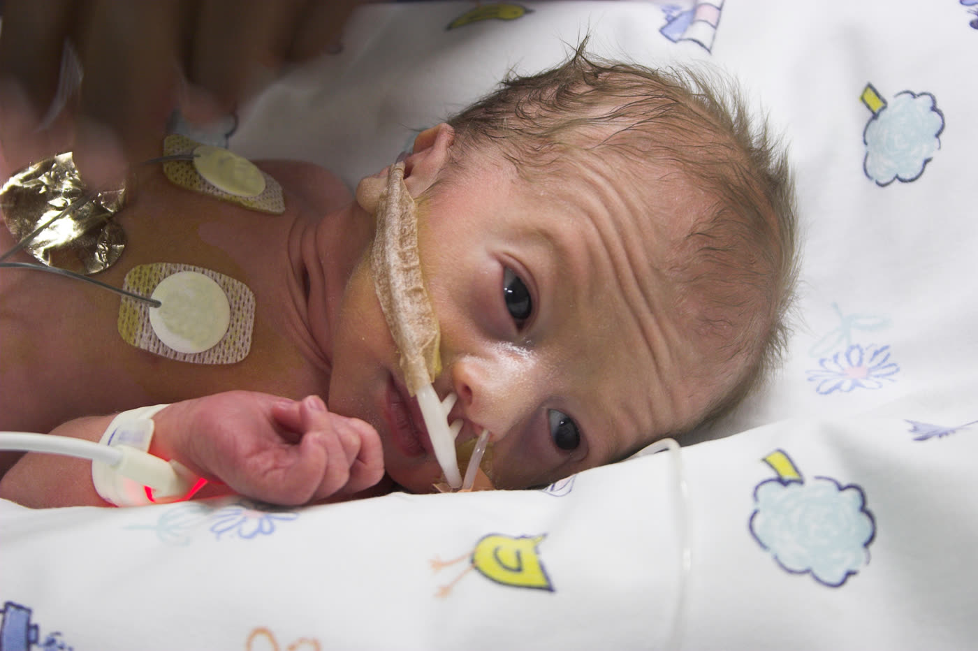 Premature infant receiving neonatal intensive care